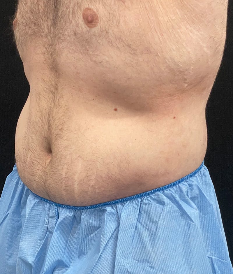Male Lower Body Lift Before & After Gallery - Patient 376758 - Image 4