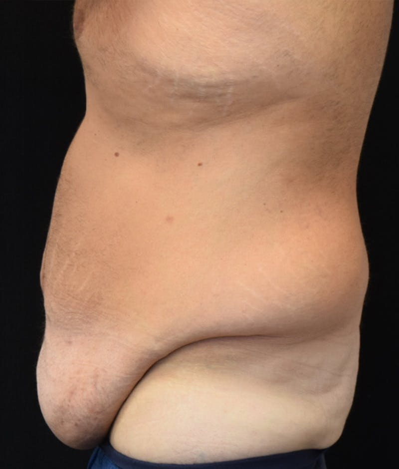 Male Lower Body Lift Before & After Gallery - Patient 376758 - Image 5