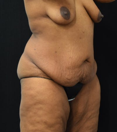 Lower Body Lift Before & After Gallery - Patient 220292 - Image 1