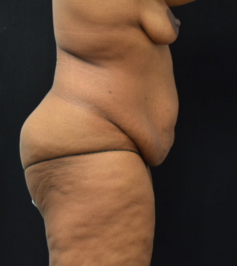 Lower Body Lift Before & After Gallery - Patient 220292 - Image 3