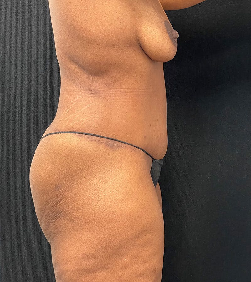 Lower Body Lift Before & After Gallery - Patient 220292 - Image 4
