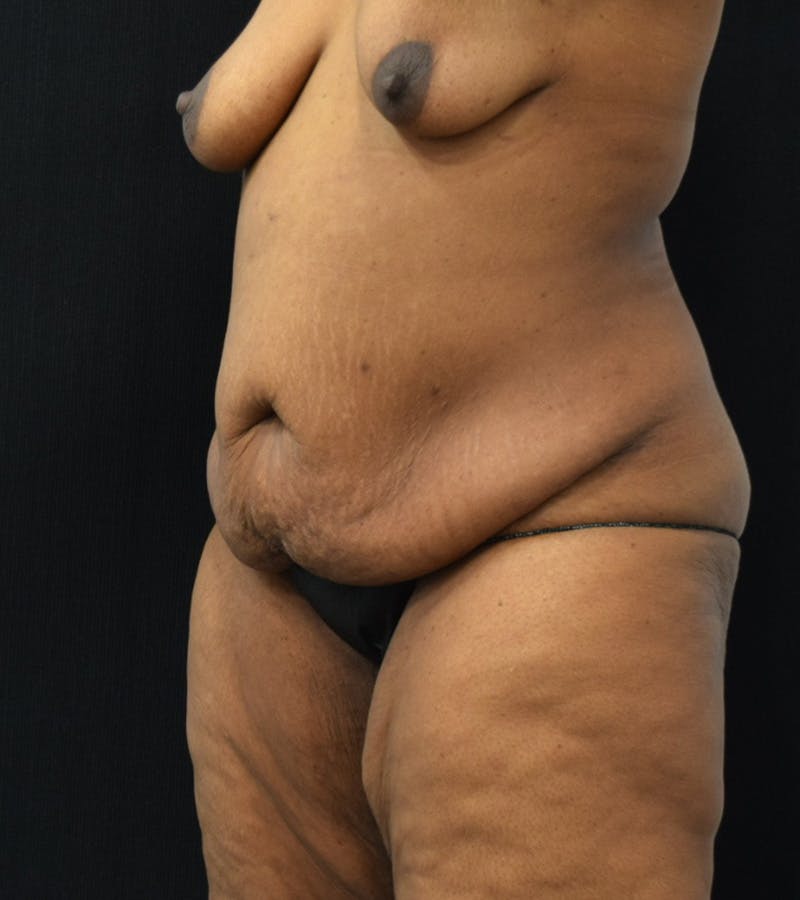 Lower Body Lift Before & After Gallery - Patient 220292 - Image 5