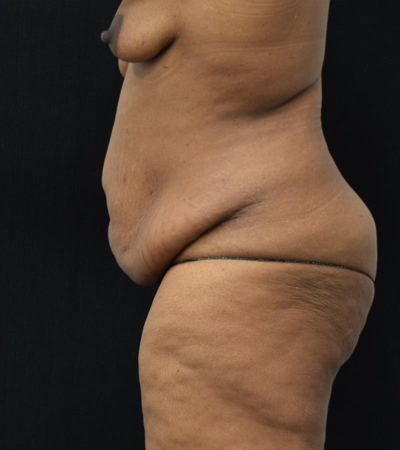 Lower Body Lift Before & After Gallery - Patient 220292 - Image 7