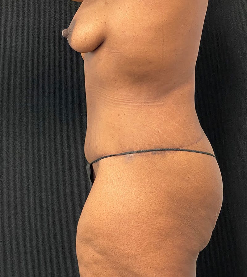 Lower Body Lift Before & After Gallery - Patient 220292 - Image 8