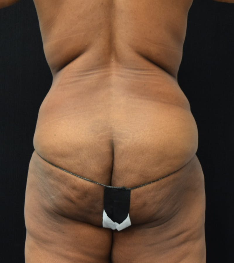 Lower Body Lift Before & After Gallery - Patient 220292 - Image 9