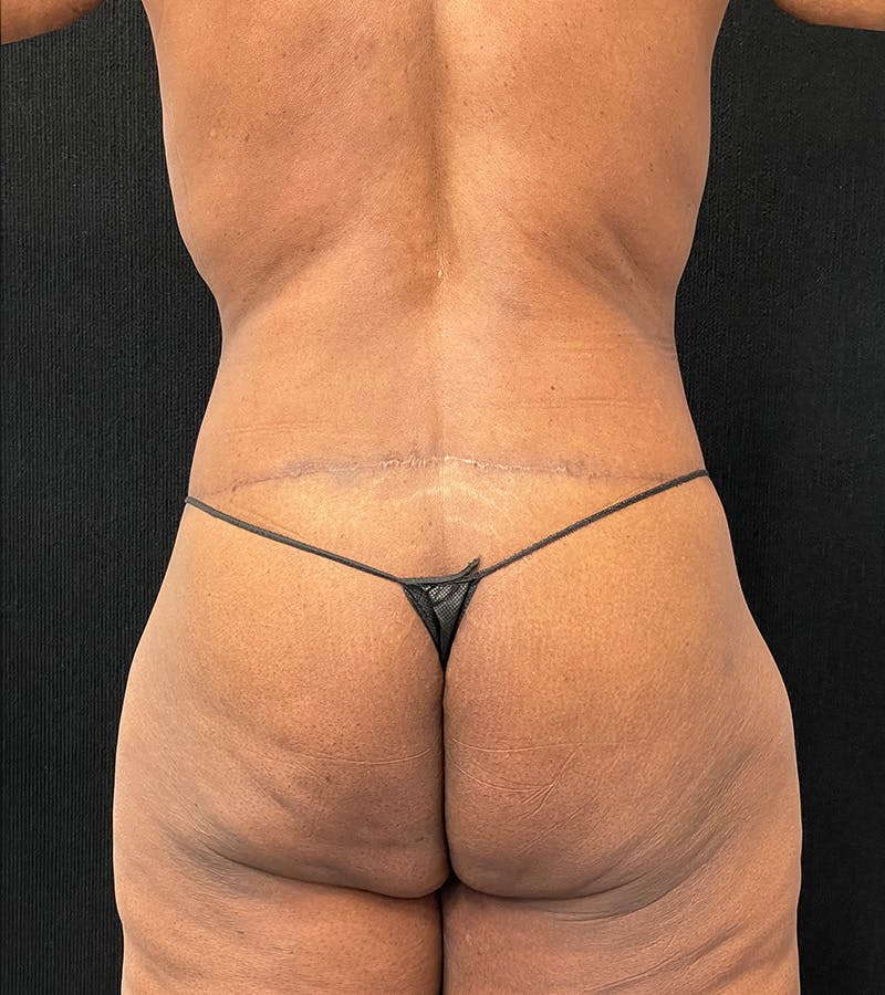 Lower Body Lift Before & After Gallery - Patient 220292 - Image 10