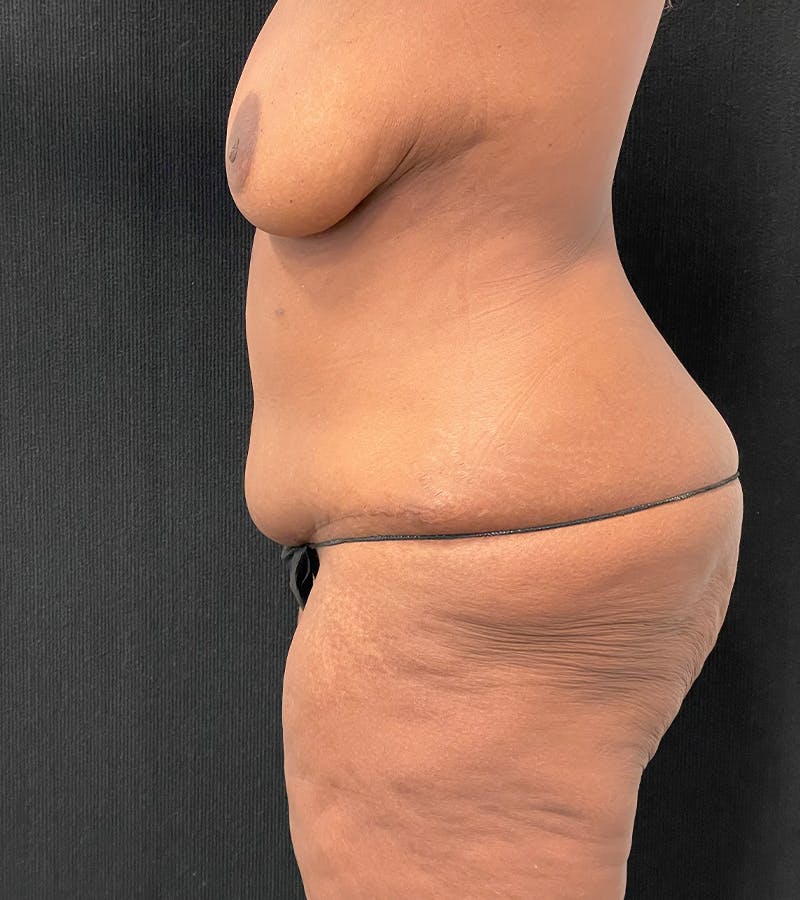 Lower Body Lift Before & After Gallery - Patient 185704 - Image 5