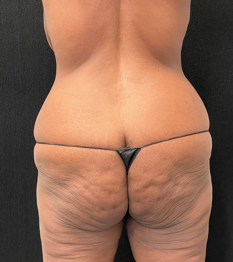 Lower Body Lift Before & After Gallery - Patient 185704 - Image 7
