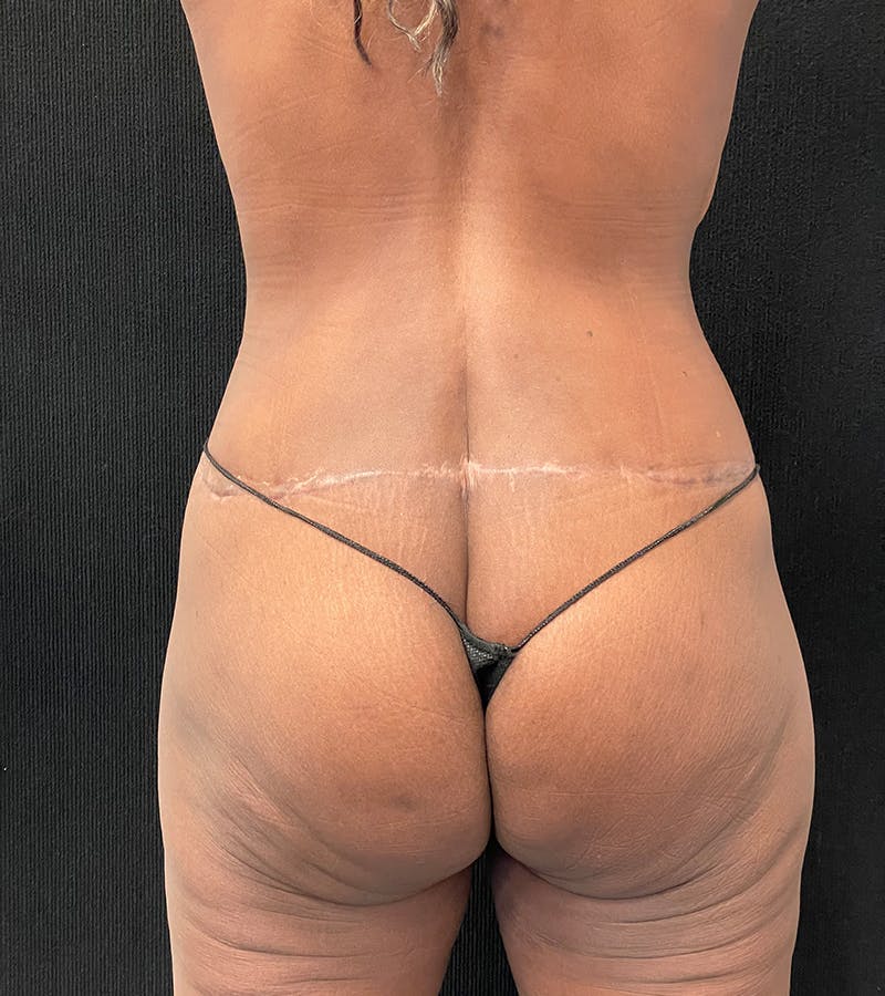 Lower Body Lift Before & After Gallery - Patient 185704 - Image 8