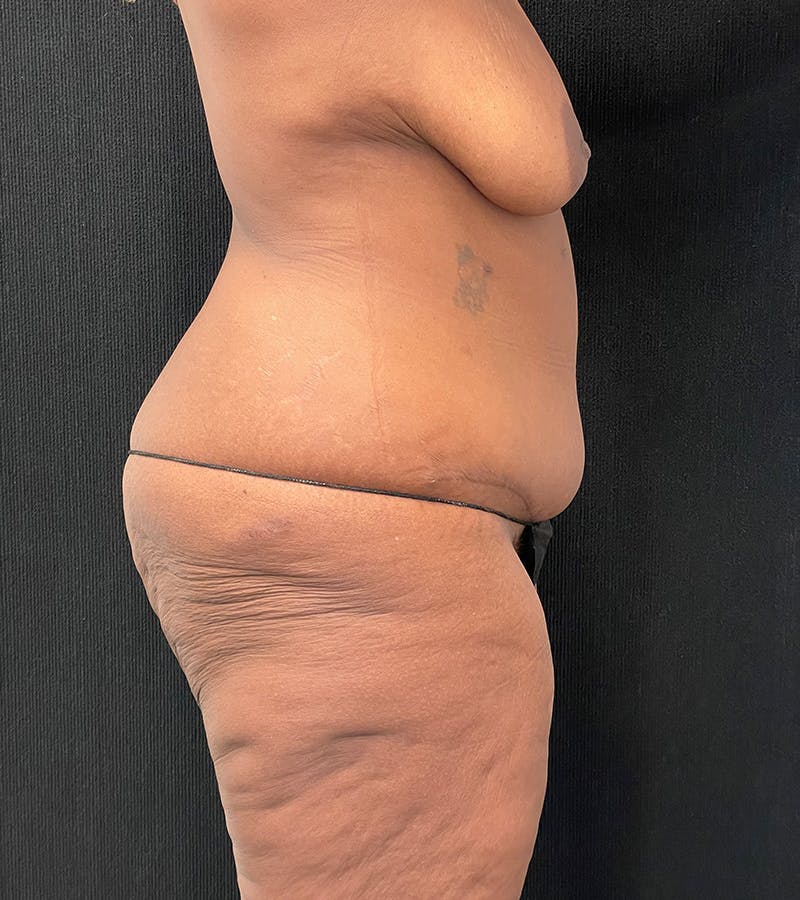 Lower Body Lift Before & After Gallery - Patient 185704 - Image 9