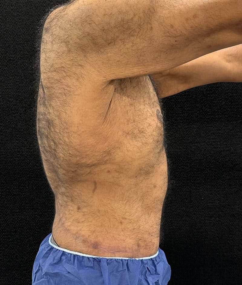 Male Lower Body Lift Before & After Gallery - Patient 241109 - Image 10