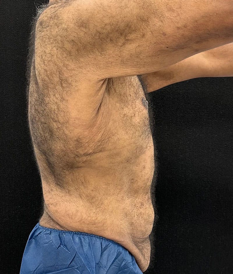 Male Lower Body Lift Before & After Gallery - Patient 241109 - Image 9