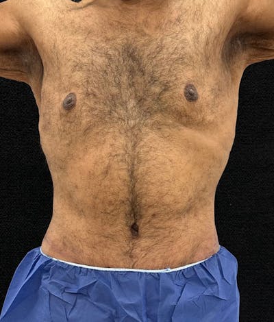 Male Lower Body Lift Before & After Gallery - Patient 241109 - Image 2