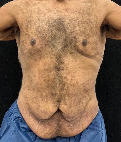 Male Lower Body Lift Before & After Gallery - Patient 241109 - Image 1