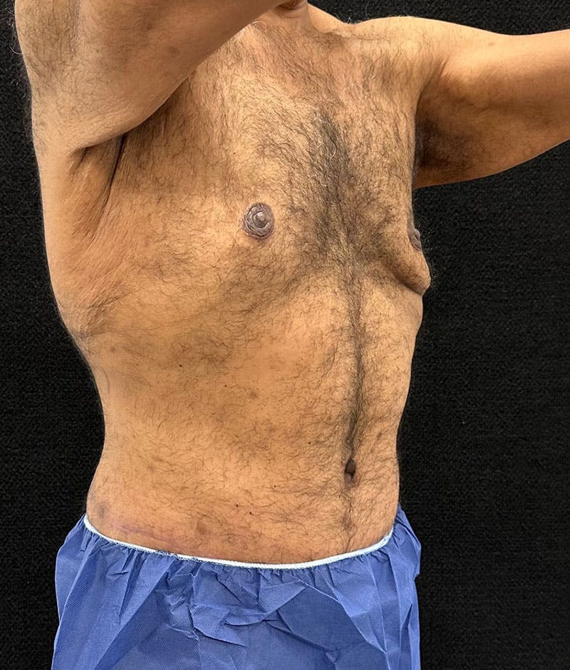Male Lower Body Lift Before & After Gallery - Patient 241109 - Image 12