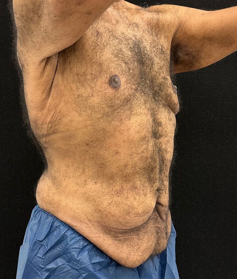 Male Lower Body Lift Before & After Gallery - Patient 241109 - Image 11