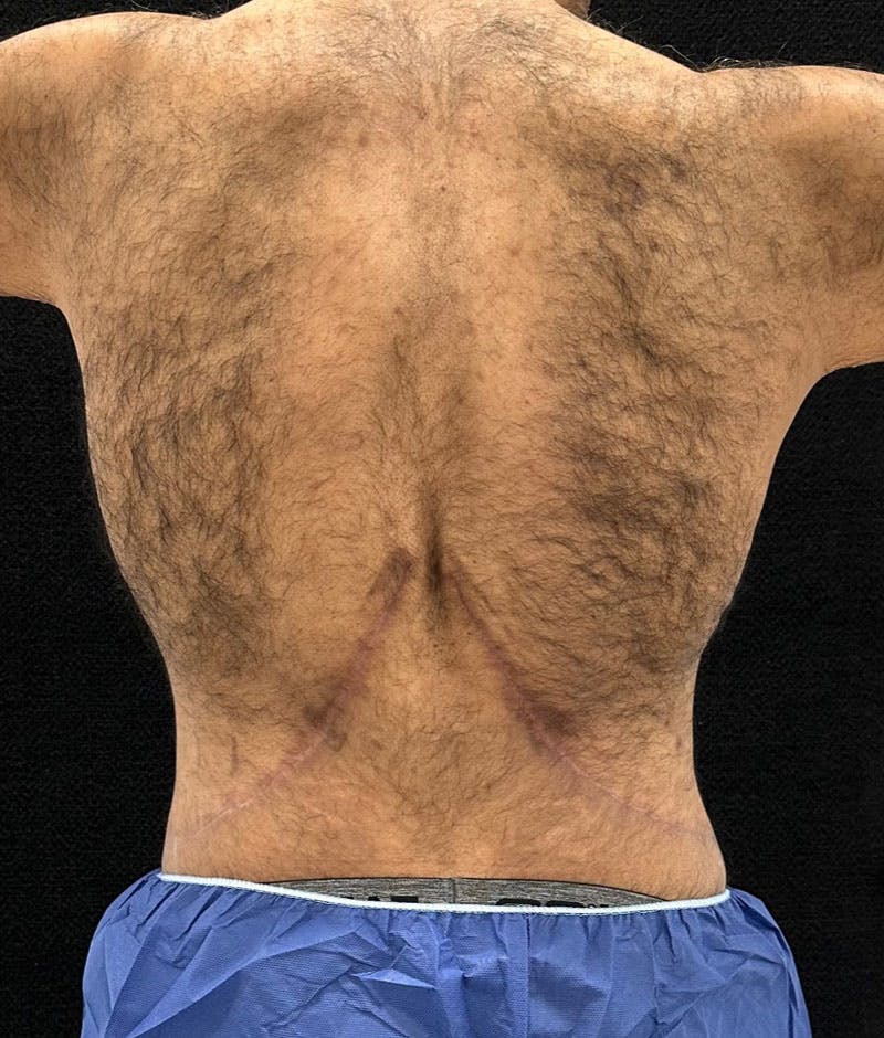 Male Lower Body Lift Before & After Gallery - Patient 241109 - Image 8
