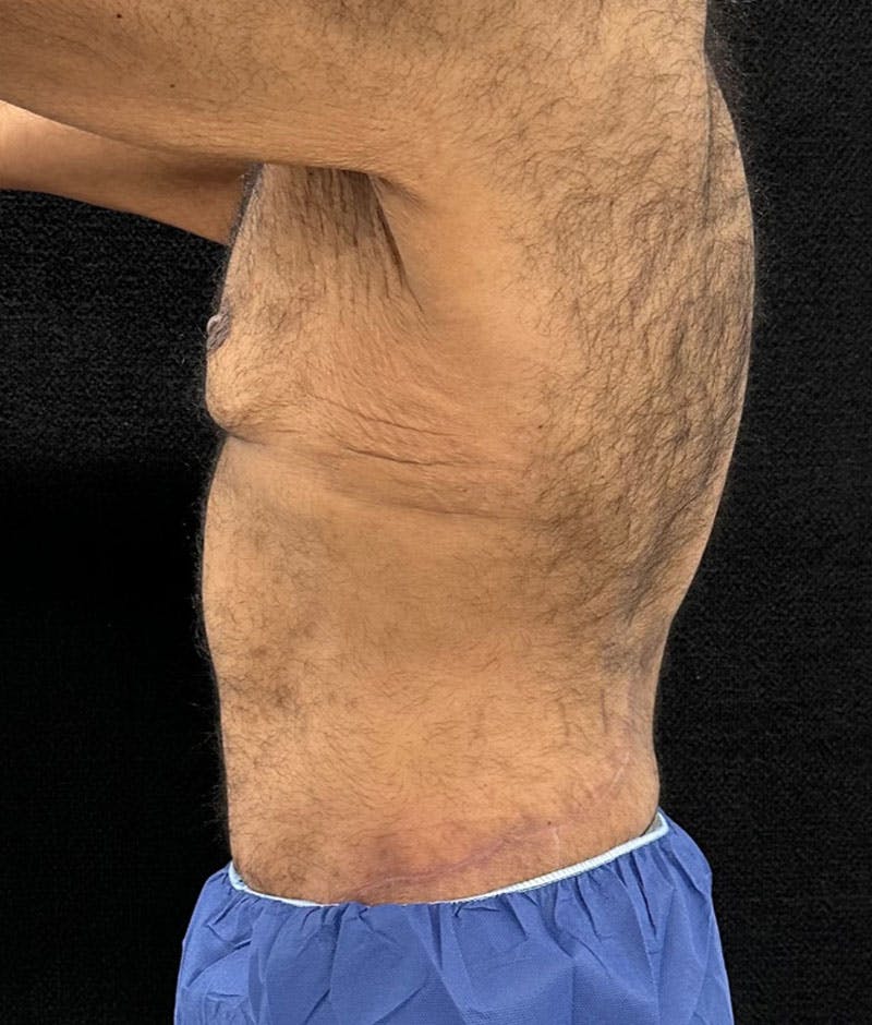 Male Lower Body Lift Before & After Gallery - Patient 241109 - Image 6