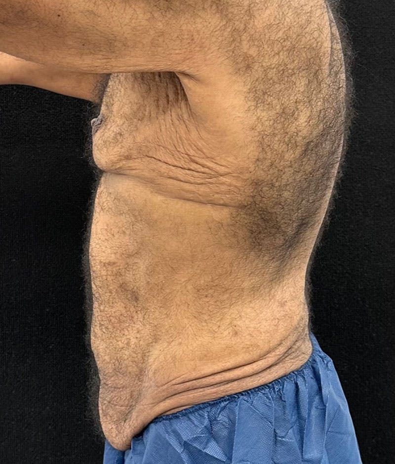 Male Lower Body Lift Before & After Gallery - Patient 241109 - Image 5