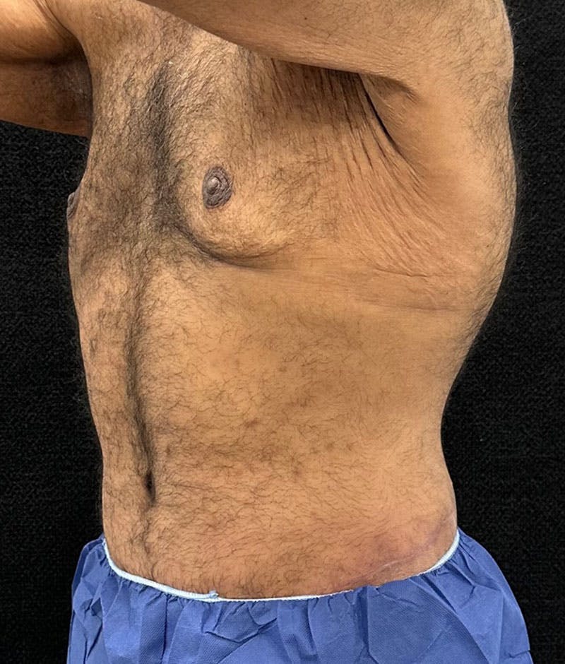 Male Lower Body Lift Before & After Gallery - Patient 241109 - Image 4
