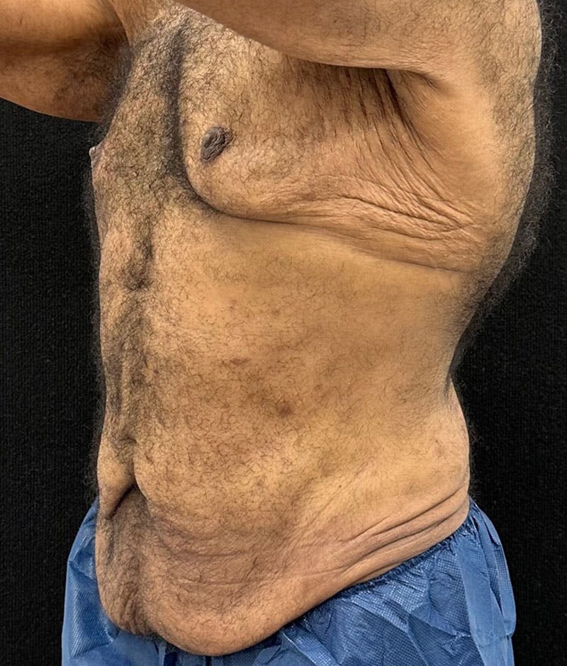 Male Lower Body Lift Before & After Gallery - Patient 241109 - Image 3