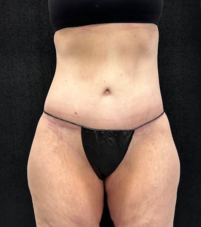 Lower Body Lift Before & After Gallery - Patient 416332 - Image 2
