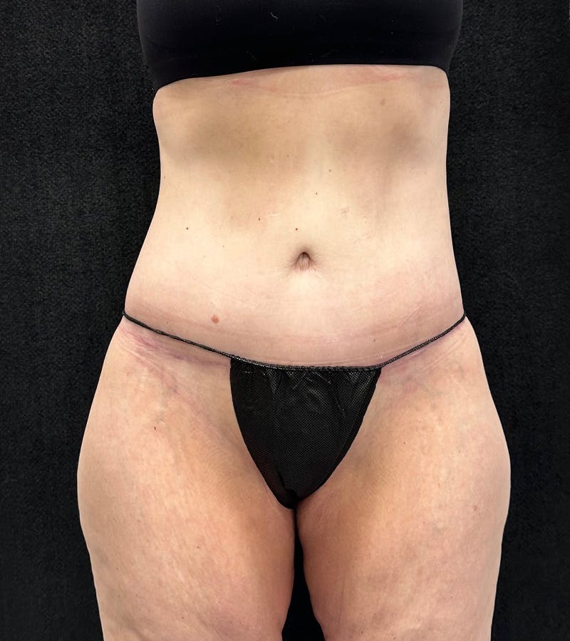 Lower Body Lift Before & After Gallery - Patient 416332 - Image 2