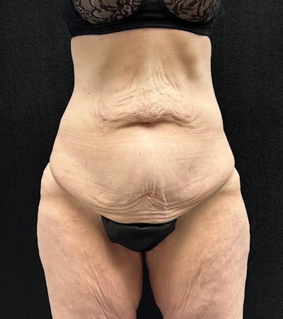 Lower Body Lift Before & After Gallery - Patient 416332 - Image 1