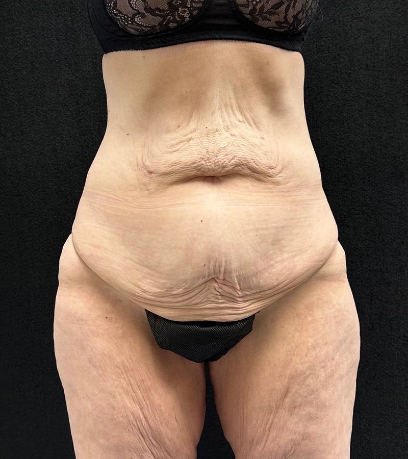 Lower Body Lift Before & After Gallery - Patient 416332 - Image 1