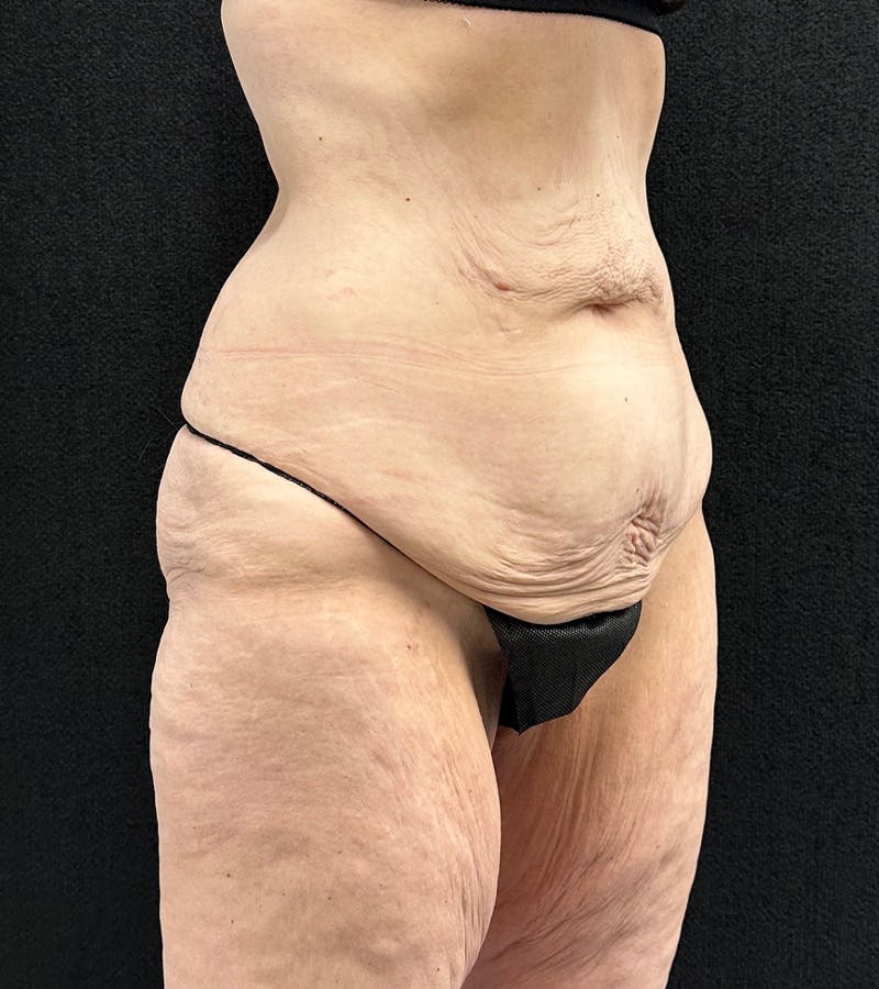 Lower Body Lift Before & After Gallery - Patient 416332 - Image 3