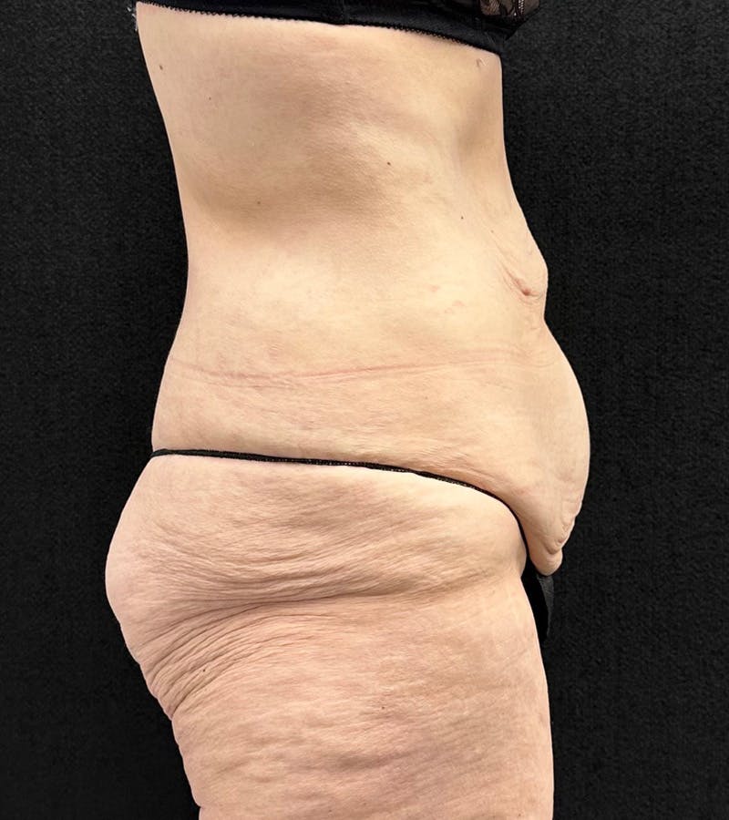Lower Body Lift Before & After Gallery - Patient 416332 - Image 5