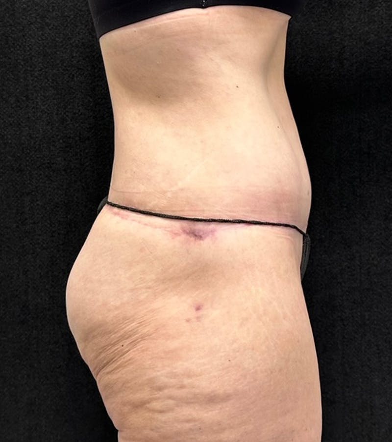 Lower Body Lift Before & After Gallery - Patient 416332 - Image 6