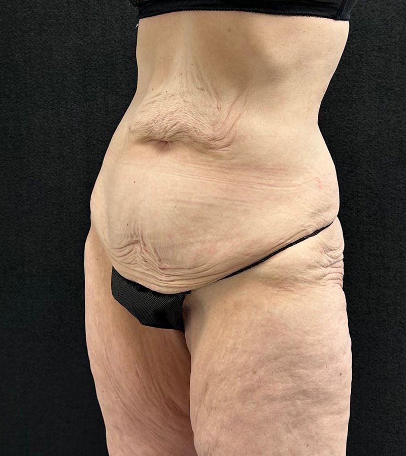 Lower Body Lift Before & After Gallery - Patient 416332 - Image 7
