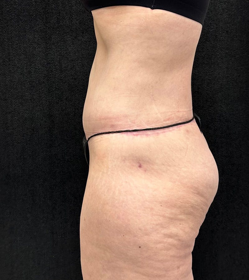 Lower Body Lift Before & After Gallery - Patient 416332 - Image 10