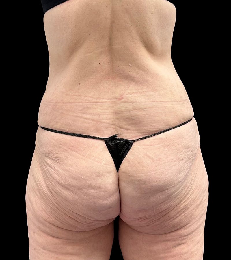 Lower Body Lift Before & After Gallery - Patient 416332 - Image 11