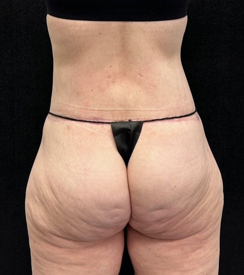 Lower Body Lift Before & After Gallery - Patient 416332 - Image 12