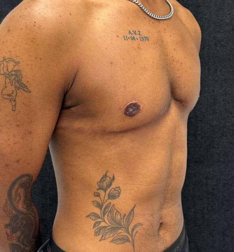 FTM Top Surgery Before & After Gallery - Patient 685622 - Image 10