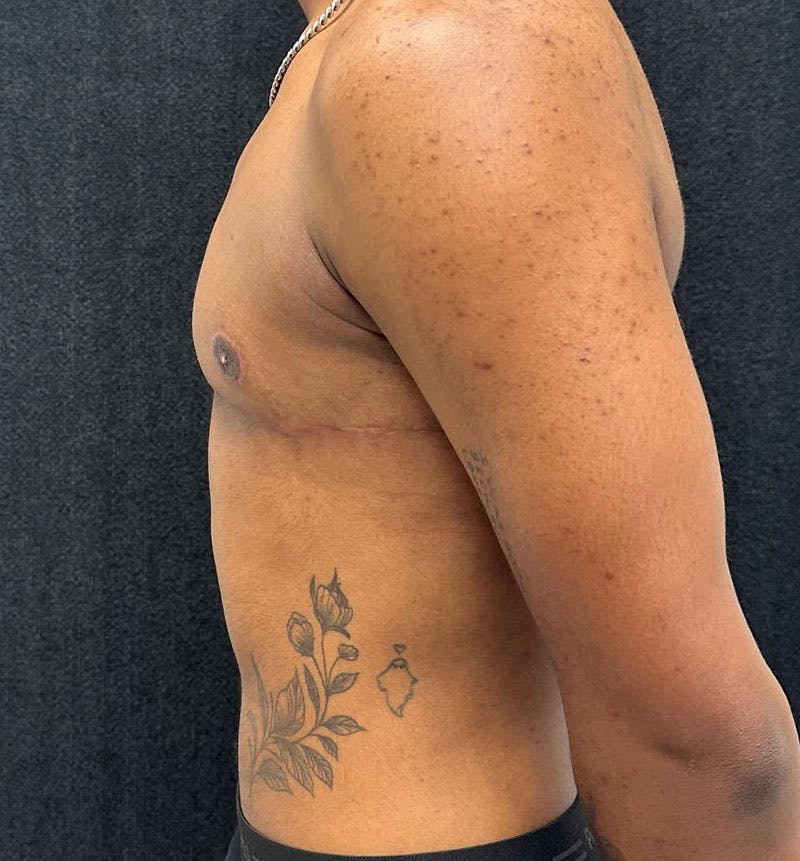 FTM Top Surgery Before & After Gallery - Patient 685622 - Image 6