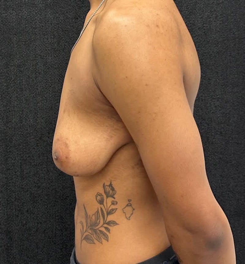 FTM Top Surgery Before & After Gallery - Patient 685622 - Image 5