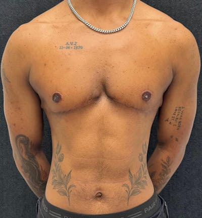 FTM Top Surgery Before & After Gallery - Patient 685622 - Image 2