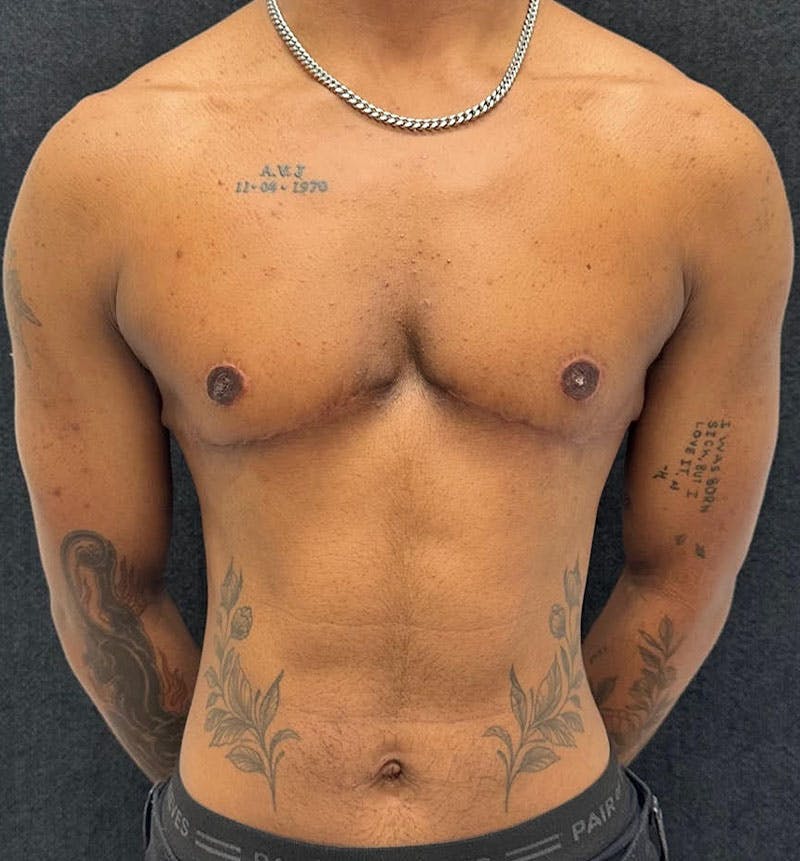 FTM Top Surgery Before & After Gallery - Patient 685622 - Image 2