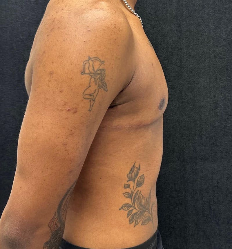 FTM Top Surgery Before & After Gallery - Patient 685622 - Image 8