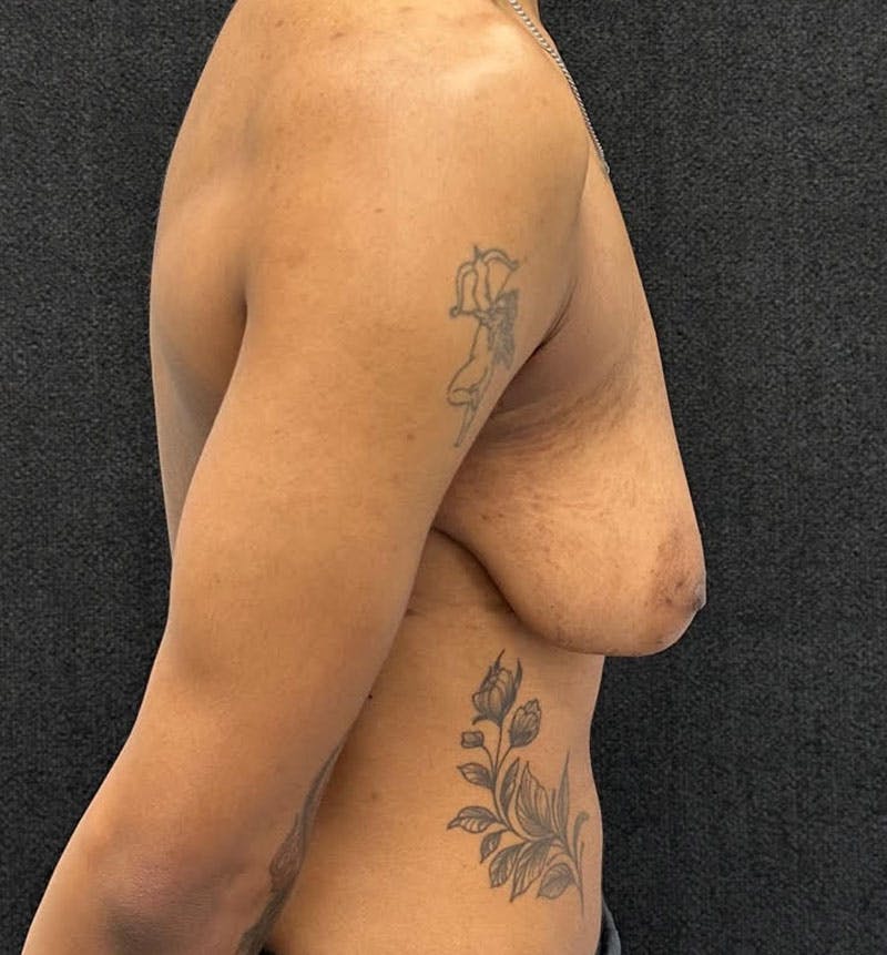 FTM Top Surgery Before & After Gallery - Patient 685622 - Image 7