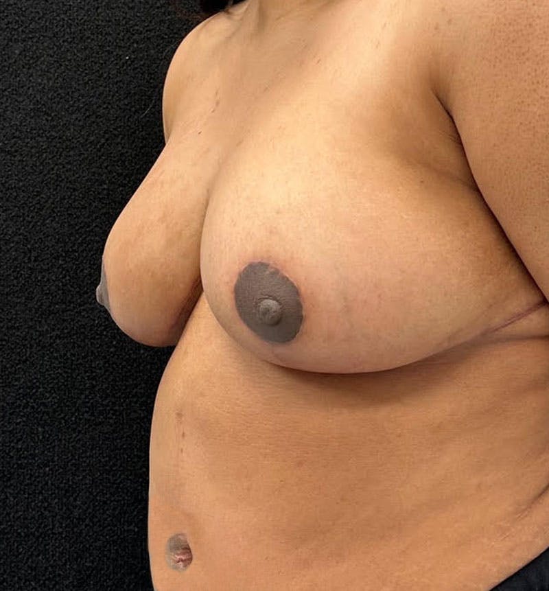 Breast Reduction Before & After Gallery - Patient 813326 - Image 4