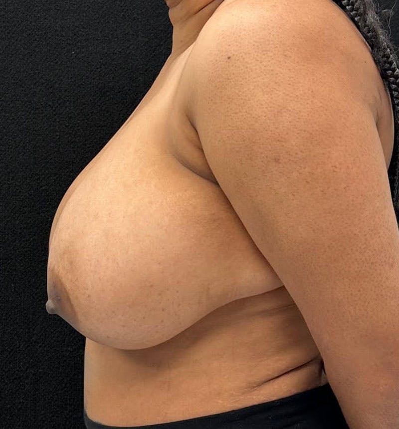 Breast Reduction Before & After Gallery - Patient 813326 - Image 5