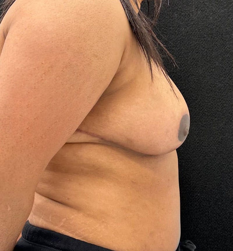 Breast Reduction Before & After Gallery - Patient 813326 - Image 8