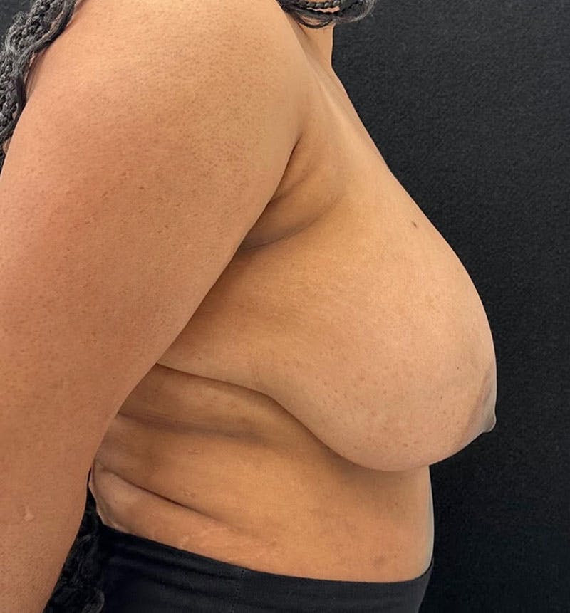 Breast Reduction Before & After Gallery - Patient 813326 - Image 7