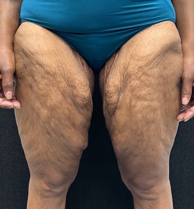 Thigh Lift Before & After Gallery - Patient 385533 - Image 1