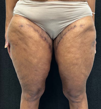 Thigh Lift Before & After Gallery - Patient 385533 - Image 2