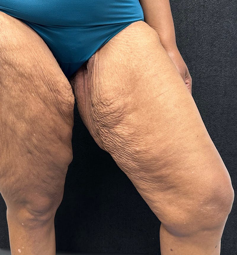 Thigh Lift Before & After Gallery - Patient 385533 - Image 3